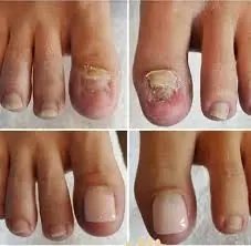 nail fungus